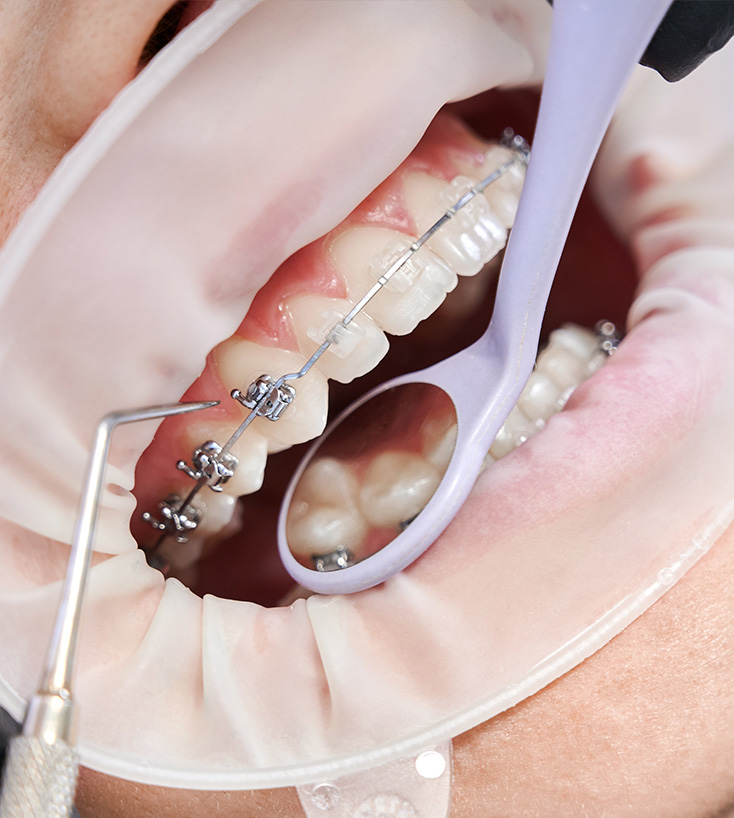 Planejamento odontológico sobre modelo e o sorriso do paciente