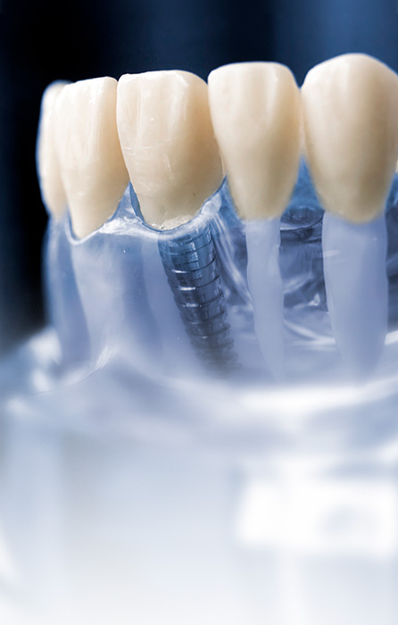 Modelo de implante dentário com coroa protética