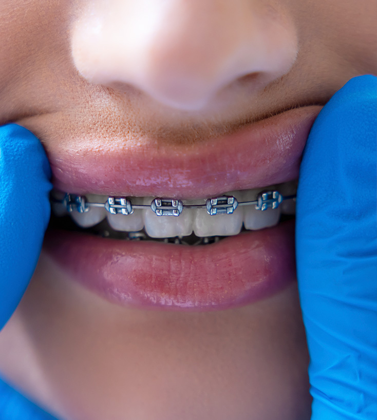 Modelo odontológico utilizado no planejamento do tratamento ortodôntico