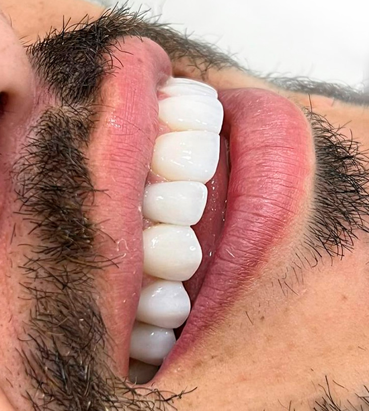 Detalhe lateral de sorriso com facetas dentárias finalizadas