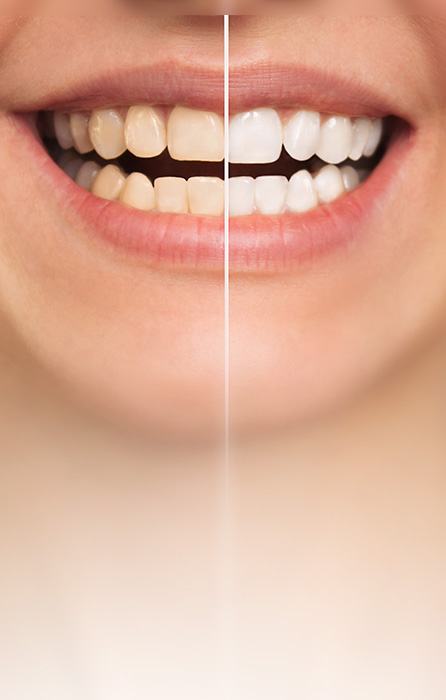 Clareamento dental