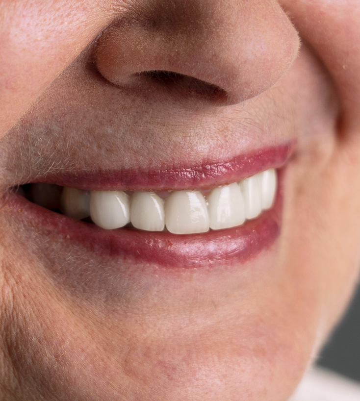 Prótese total sobre modelo e o sorriso finalizado do paciente