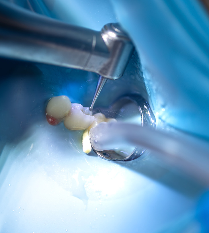 Procedimento odontológico sendo realizado com instrumento específico