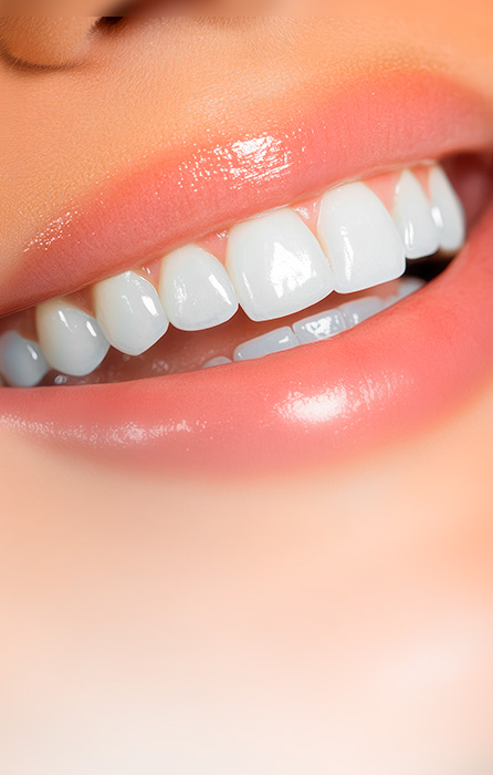 Facetas dentárias