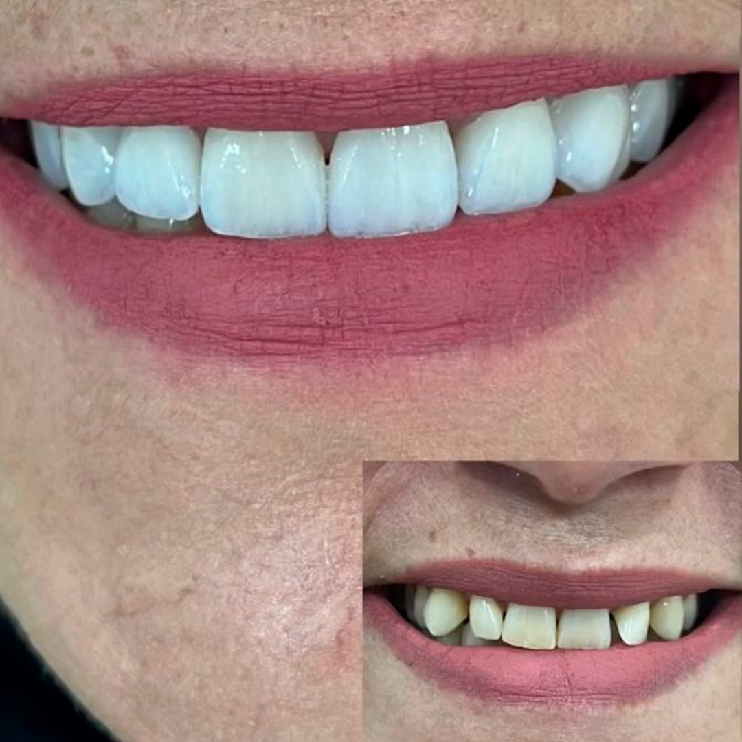 Registro clínico de antes e depois de tratamento odontológico