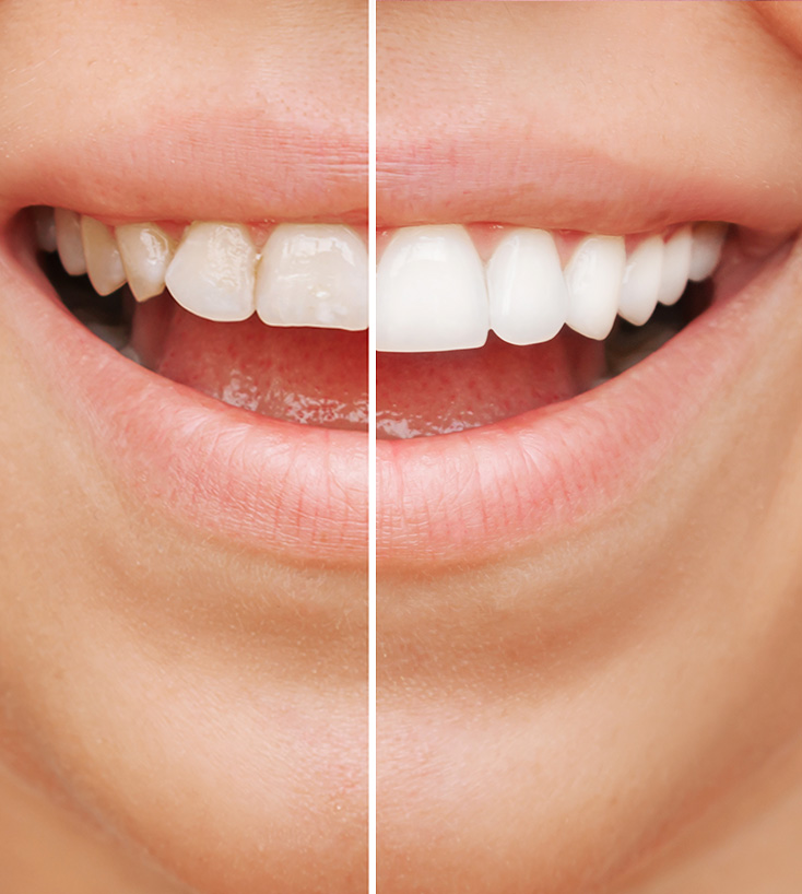 Comparativo do sorriso antes e depois do planejamento estético