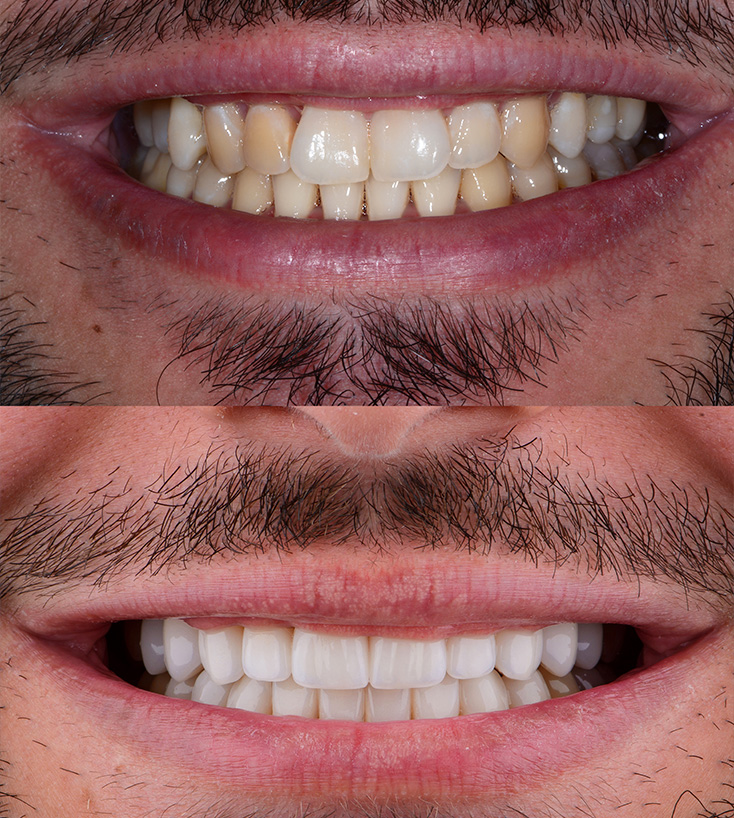 Comparativo do sorriso antes e depois do clareamento dental