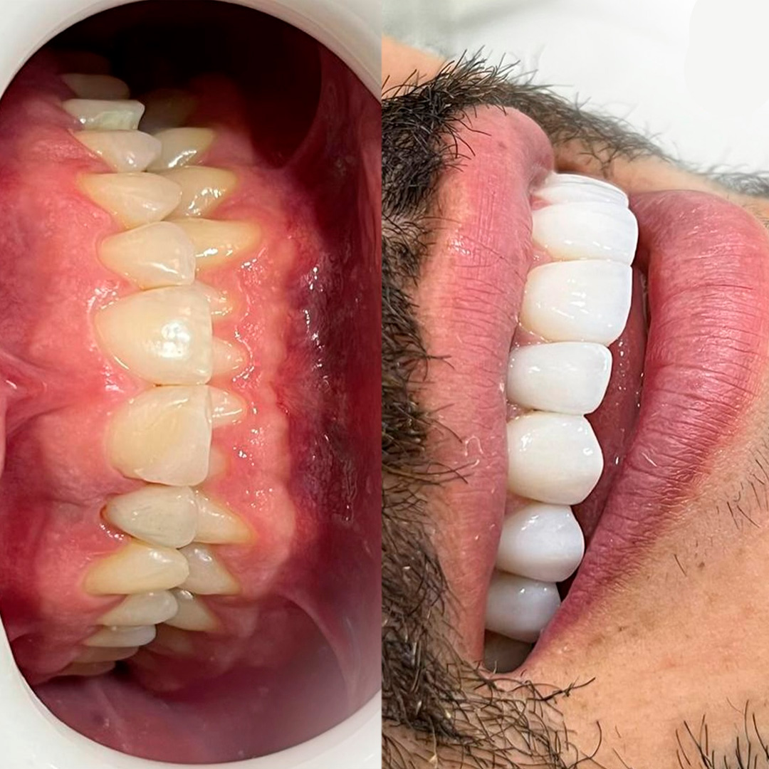 Registro clínico de antes e depois de tratamento odontológico