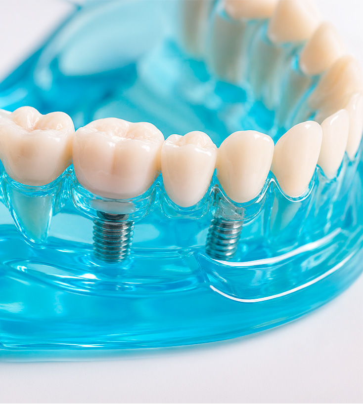 Modelo didático mostrando implantes dentários sustentando coroas protéticas