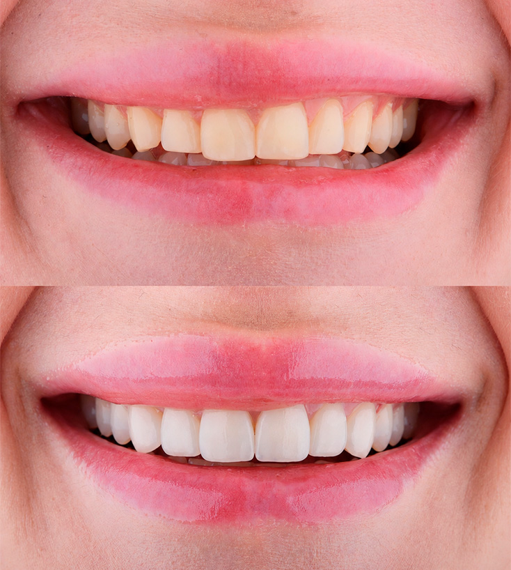 Sorriso antes e depois do clareamento, mostrando a evolução da tonalidade