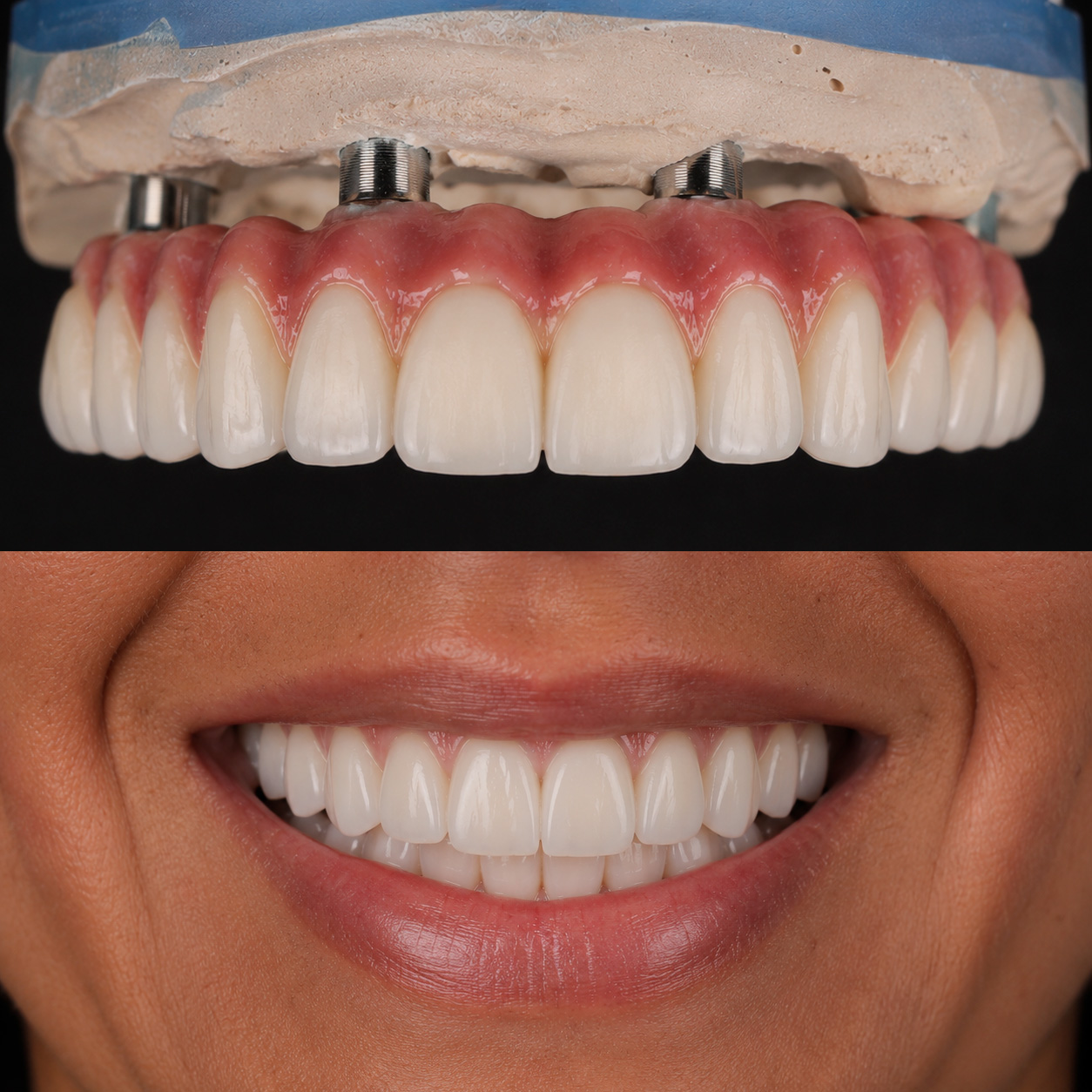 Prótese protocolo sobre modelo e o sorriso finalizado do paciente